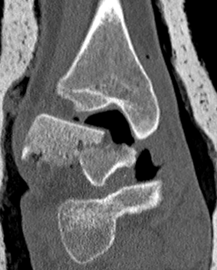 CT Talar Dome Fracture